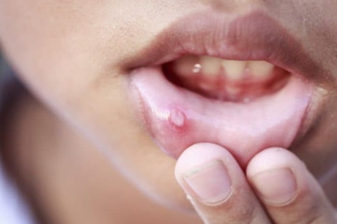 awas_sariawan_salah_satu_gejala_diabetes