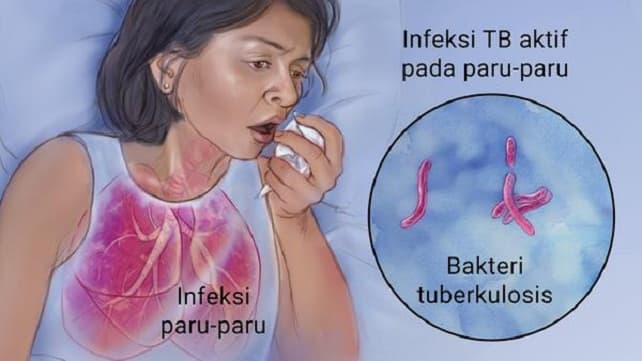 gawat_14_15_orang_per_jam_tewas_karena_tbc