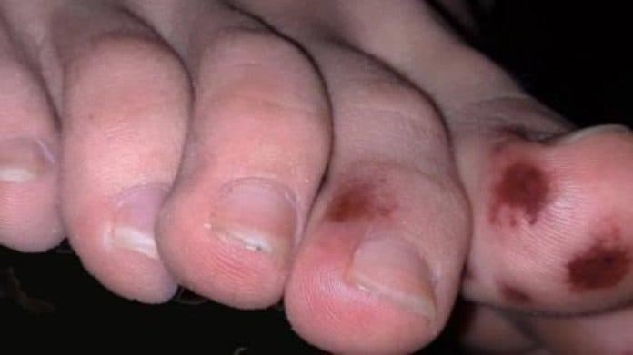 gejala_corona_bisa_dilihat_dari_kaki