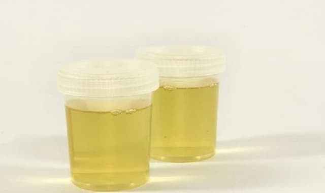 indikasi_dan_penyebab_risiko_urine_berdarah