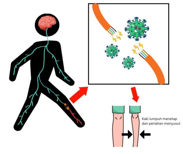penyakit_polio_pada_anak_di_sumut_nihil