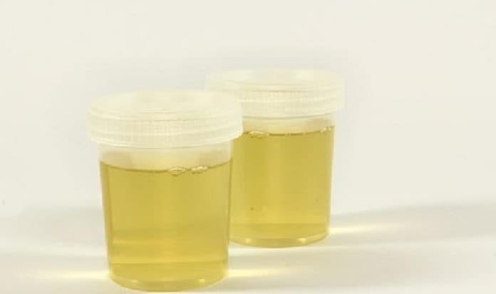penyebab_urine_berwarna_kuning