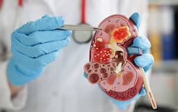 penyakit_ginjal_kronis_berawal_dari_kondisi_tertentu_dokter_gaya_hidup_tak_sehat_jadi_pemicu