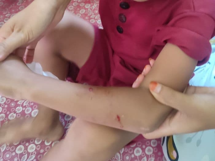 anjing_rabies_gigit_7_warga_tanah_jawa_korban_dalam_pemantauan