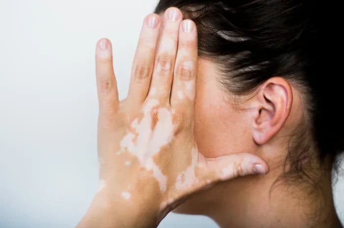 obat_kanker_dapat_sebabkan_perubahan_warna_kulit_ini_penjelasan_dokter