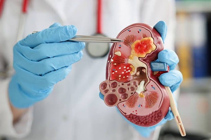 dokter_spesialis_penyakit_ginjal_kronis_tak_pandang_usia