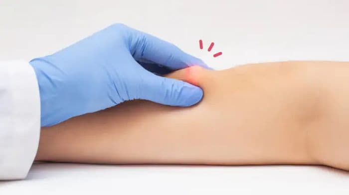 ini_ciri_bahaya_benjolan_lemak_di_bawah_kulit