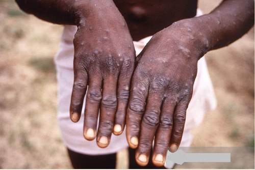 21_kasus_cacar_monyet_muncul_di_nigeria_1_tewas