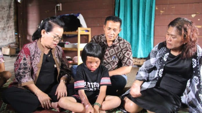 amora_purba_bocah_yang_menderita_luka_bakar_di_simalungun_akan_dioperasi_plastik
