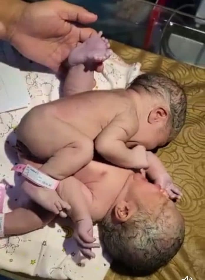 bayi_kembar_siam_dari_asahan_akhirnya_dirujuk_ke_rs_adam_malik