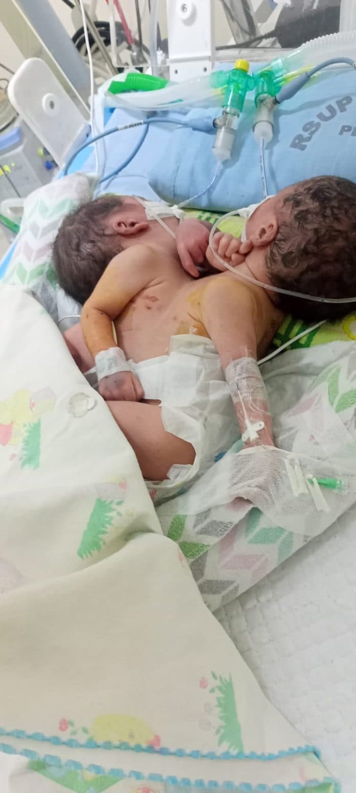 bayi_kembar_siam_di_rsup_haji_adam_malik_butuh_donor_asi