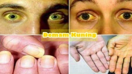 delapan_orang_di_ghana_meninggal_akibat_demam_kuning