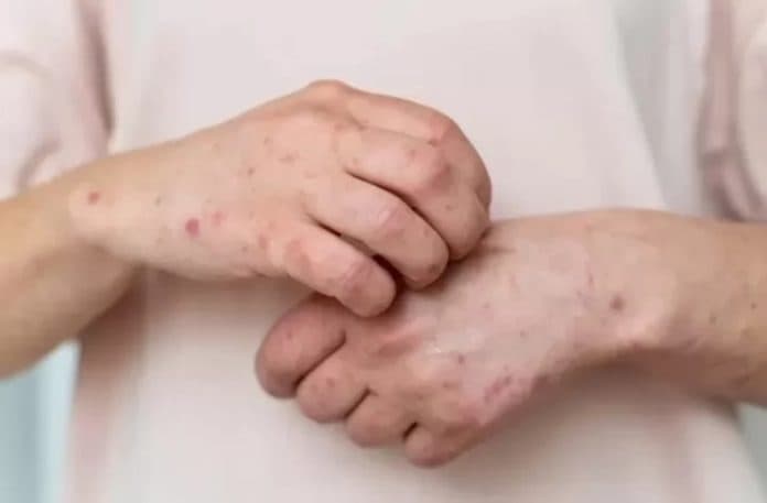 dinkes_pastikan_belum_ada_kasus_mpox_di_sumut