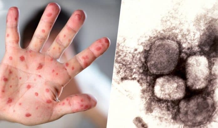 dinkes_sumut_lakukan_peningkatan_kewaspadaan_pada_monkeypox