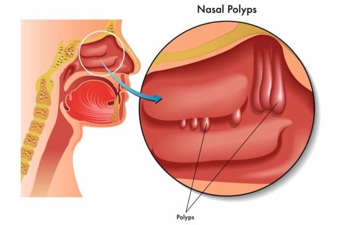 dokter_spesialis_tht_polip_hidung_dapat_sebabkan_obstructive_sleep_apnea
