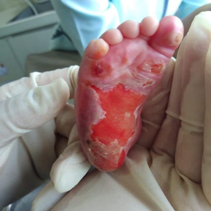 dugaan_malapraktik_kaki_bayi_polda_sumut_sudah_periksa_pelapor