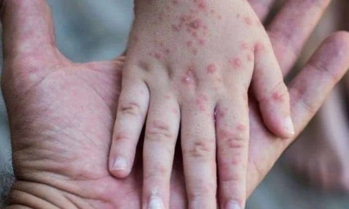 gejala_lengkap_flu_singapura_dan_cara_penularannya