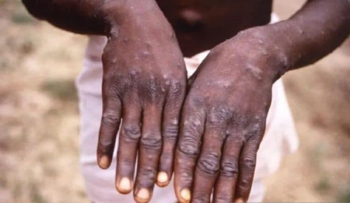 hindari_stigma_negatif_who_ubah_nama_cacar_monyet_jadi_mpox
