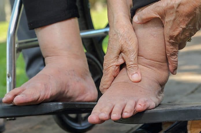 jumlah_penderita_kaki_gajah_di_indonesia_masih_memprihatinkan