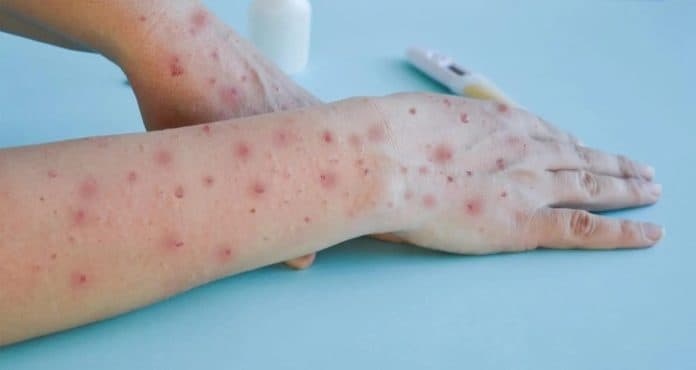 kenali_gejala_dan_perbedaan_mpox_dengan_cacar_air