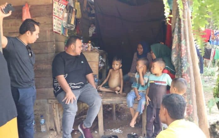 lagi_penderita_busung_lapar_ditemukan_di_palas_akhirnya_dibawa_berobat_ke_rs