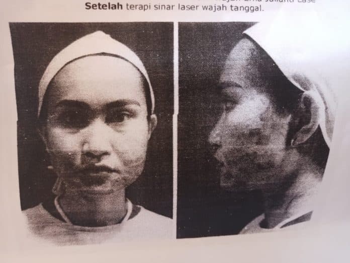 luka_saat_terapi_sinar_wajah_oknum_dokter_kecantikan_di_medan_dipolisikan_pasien