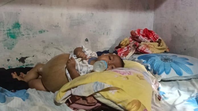 memprihatinkan_bayi_penderita_atresia_bilier_di_medan_butuh_uluran_tangan