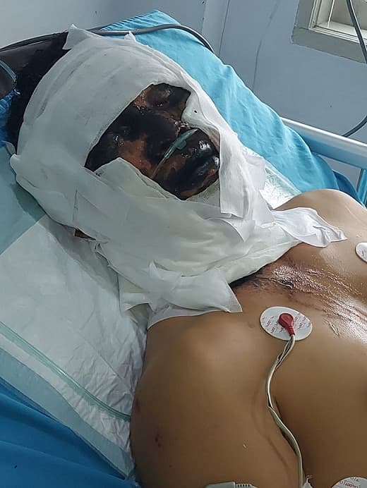 penyerangan_dengan_air_keras_diduga_bermotif_asmara