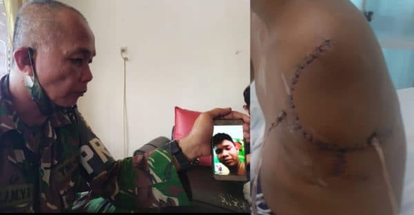 tangan_kiri_warga_asrama_rindam_terpaksa_diamputasi_ini_penyebabnya