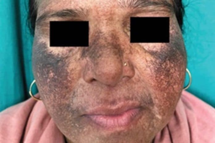 wajah_wanita_ini_menghitam_setelah_pakai_krim_pencerah